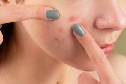 acne scars Prevention Tips