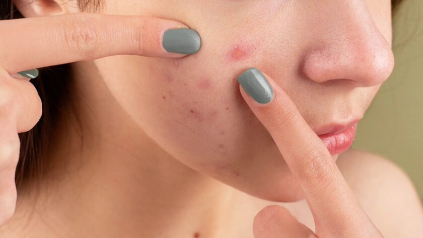 acne scars Prevention Tips